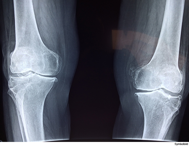 Online-Veranstaltung zum Thema „Arthrose und Gelenkersatz“